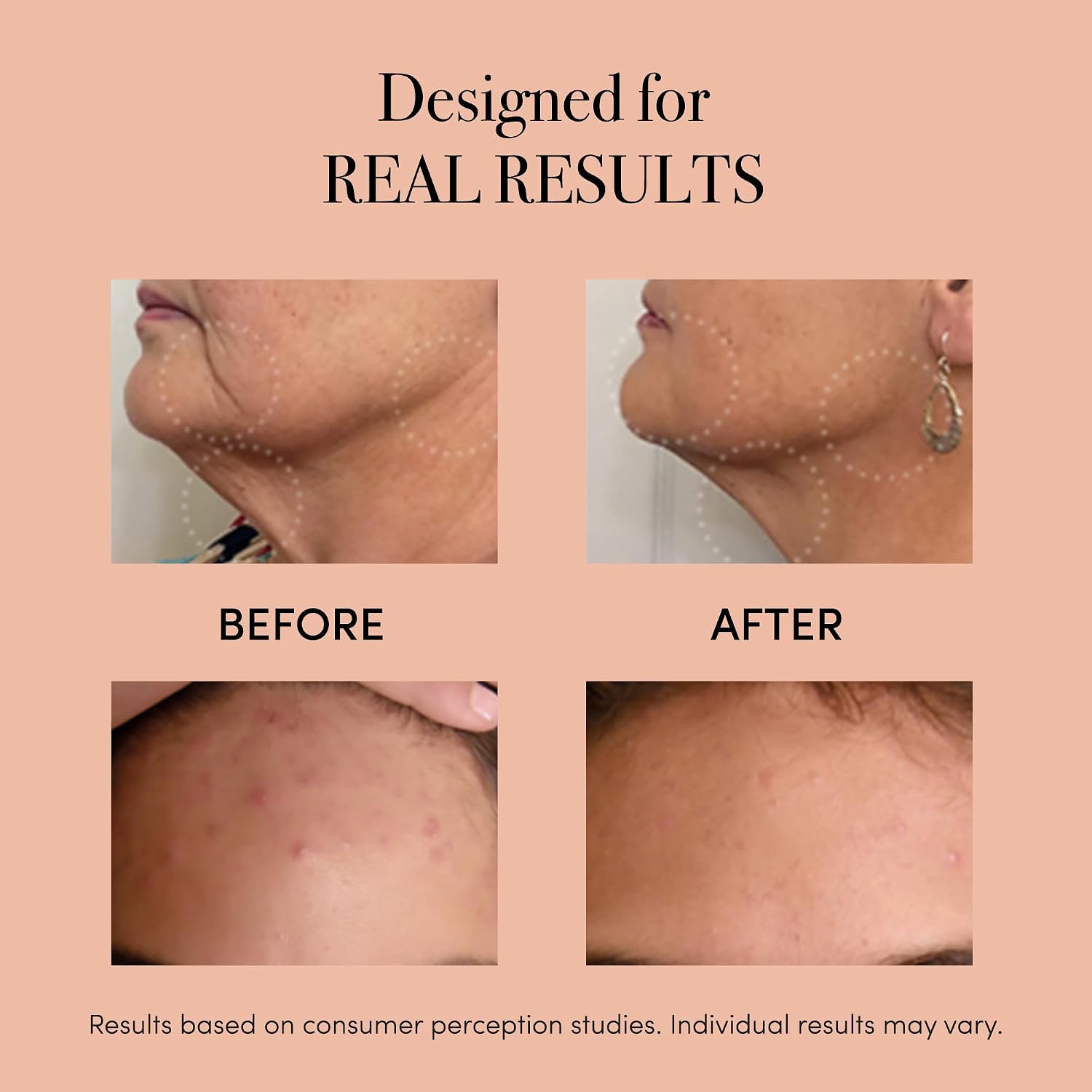 reVive Light Therapy Lux Collection Clinical Device for Aging and Acne, Red, Infrared & Blue Light Therapy Products for Wrinkles, Fine Lines, and Breakouts, Triangular Head, At-Home Acne Tools