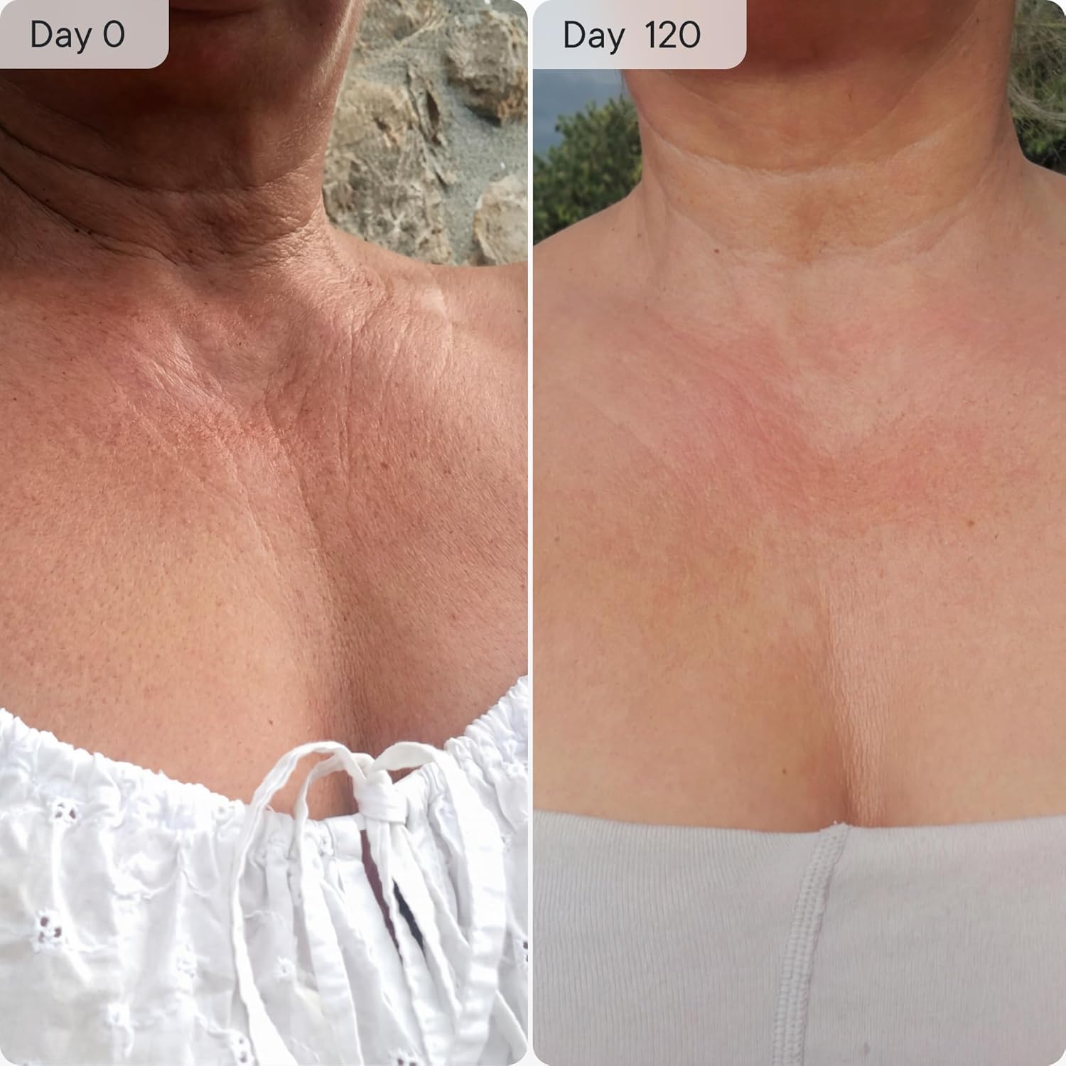 Qure Neck, Décolletage, Chest LED System, Red Light Therapy, 2 Wavelengths Red 633nm and Near-Infrared 830nm