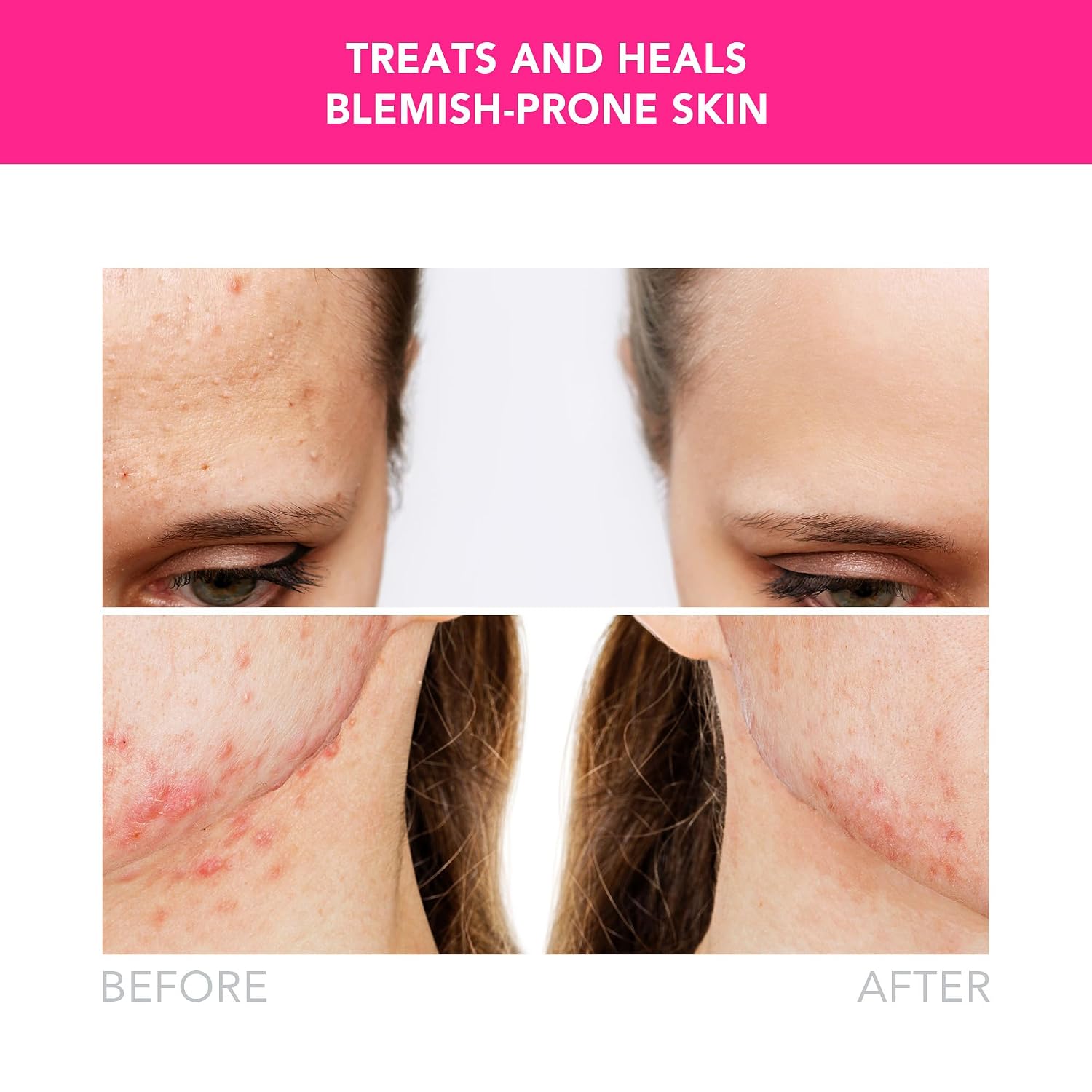 FOREO ESPADA 2 LED Light Device - Blemish Treatment Skincare Device - Medical-grade Silicone - Scar Treatment for Face - Pimple & Blemish Removal - FDA cleared - Fuchsia