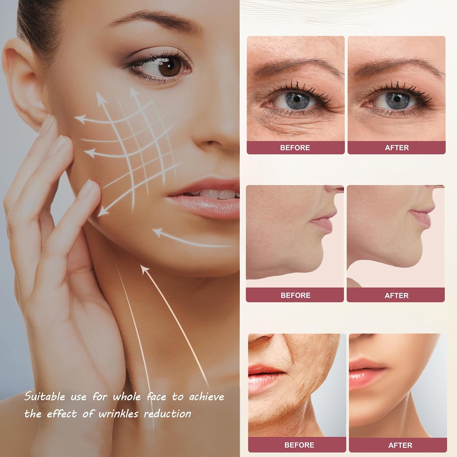 MZONG Non - Wireless RF Skin Rejuvenator - LED Light Combo for Face & Body Wrinkle Reduction