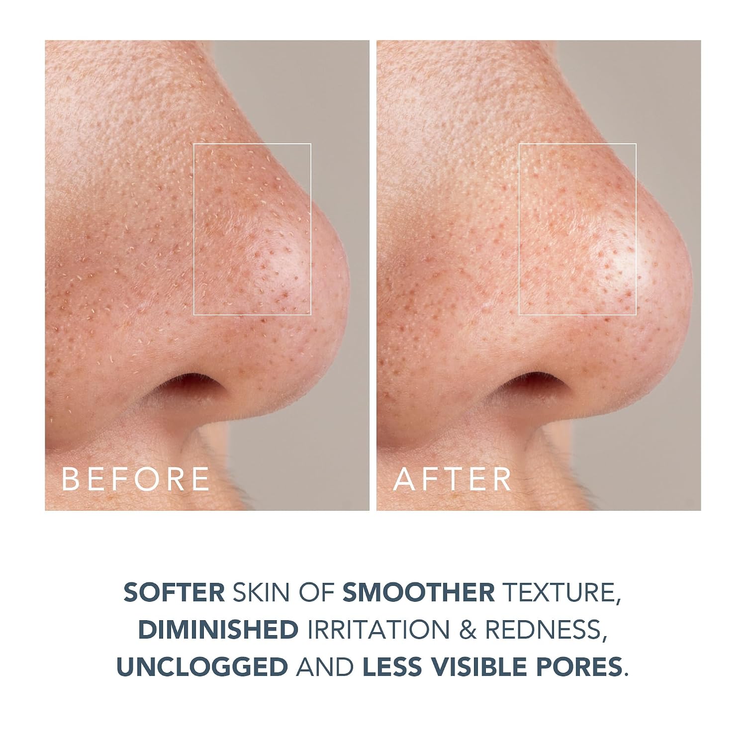 FOREO Smooth & Resurface KIWI derma Microdermabrasion Machine - Black Head Remover for Face + KIWI Active Pore & Blackhead Mask, 100g - Blackhead Extractor - No Pore Strips Suction Blackhead Remover