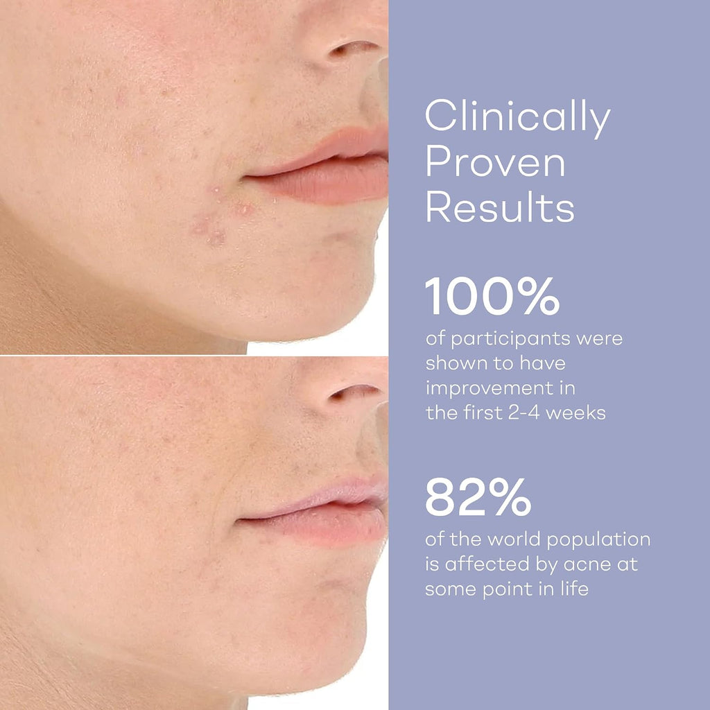 LightStim for Acne LED Red Light Therapy, FDA cleared for mild to moderate acne, reduce acne, calm existing breakouts & restore your skin's healthy appearance 36 Blue & Red LEDs, 415 & 630 wavelengths
