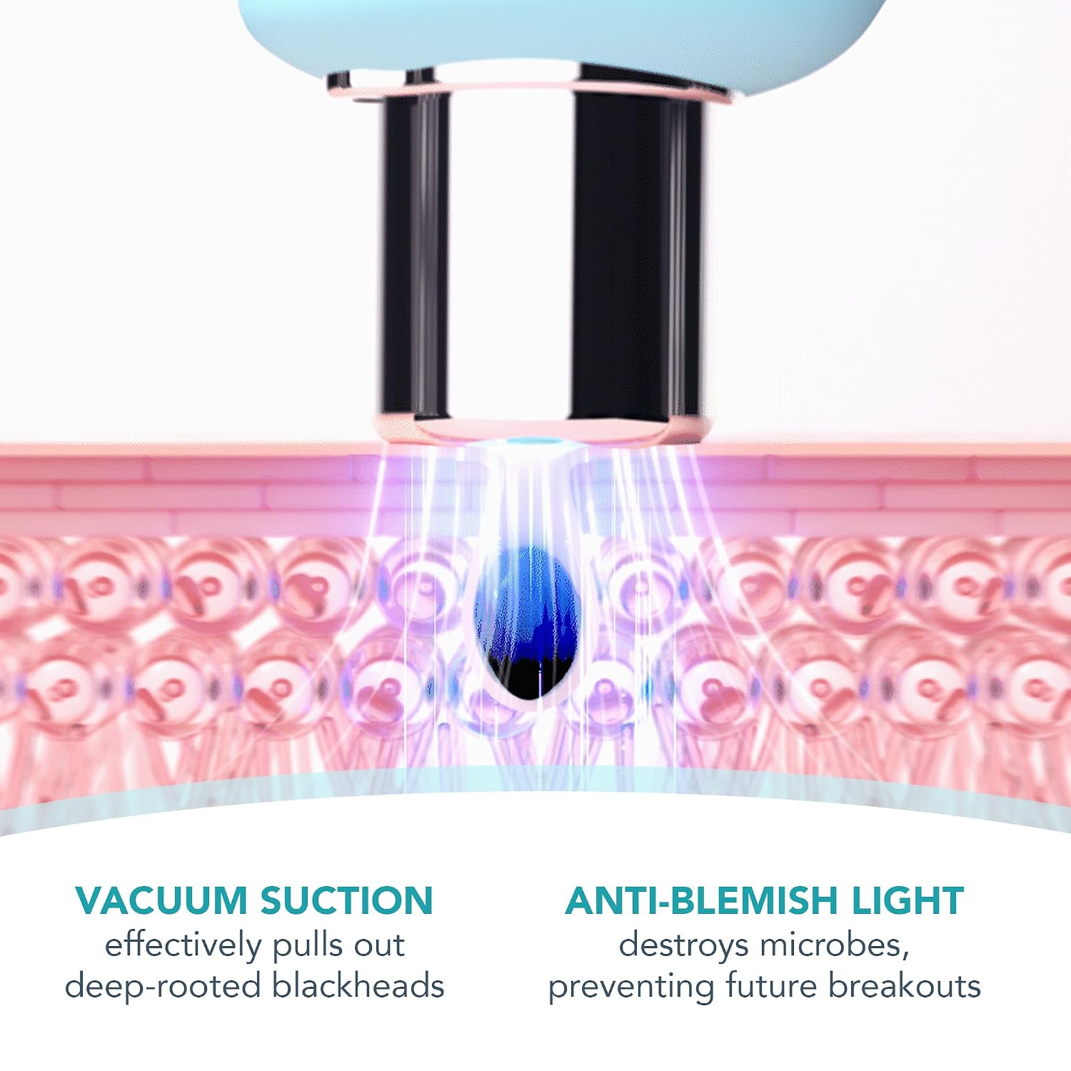 FOREO KIWI Whitehead & Black Head Remover for Face - Facial Skin Care Tools - Blackhead Extractor for Face & Nose - No Pore Strips Suction - Quick & Effective Blackhead Remover Device