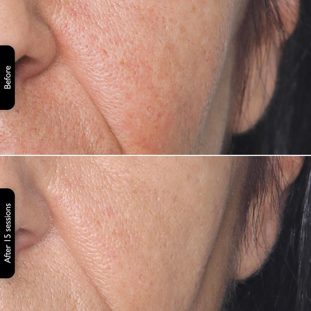 Silk'n Titan Multiplatform At-Home 3-in-1 Radio Frequency Skin Tightening Device for Face and Neck, Combines RF with Low-Level Laser Therapy & Red Light Therapy, with Thermal Sensor, Cordless