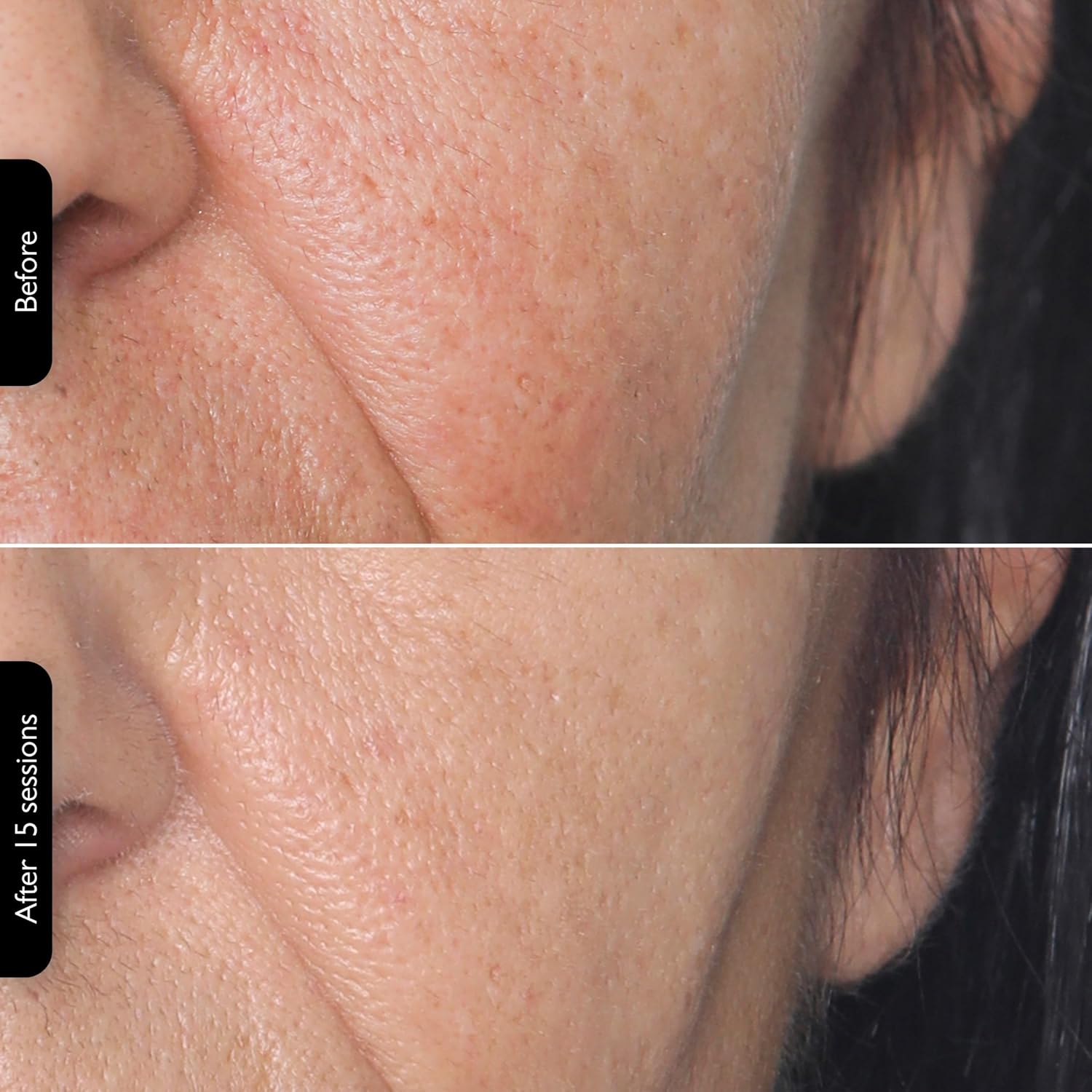 Silk'n Titan Multiplatform At-Home 3-in-1 Radio Frequency Skin Tightening Device for Face and Neck, Combines RF with Low-Level Laser Therapy & Red Light Therapy, with Thermal Sensor, Cordless