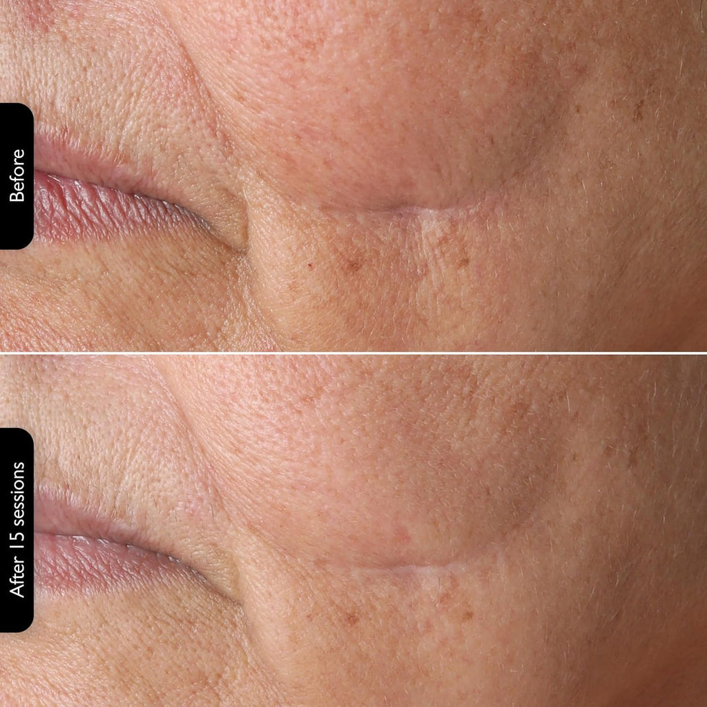 Silk'n Titan Multiplatform At-Home 3-in-1 Radio Frequency Skin Tightening Device for Face and Neck, Combines RF with Low-Level Laser Therapy & Red Light Therapy, with Thermal Sensor, Cordless