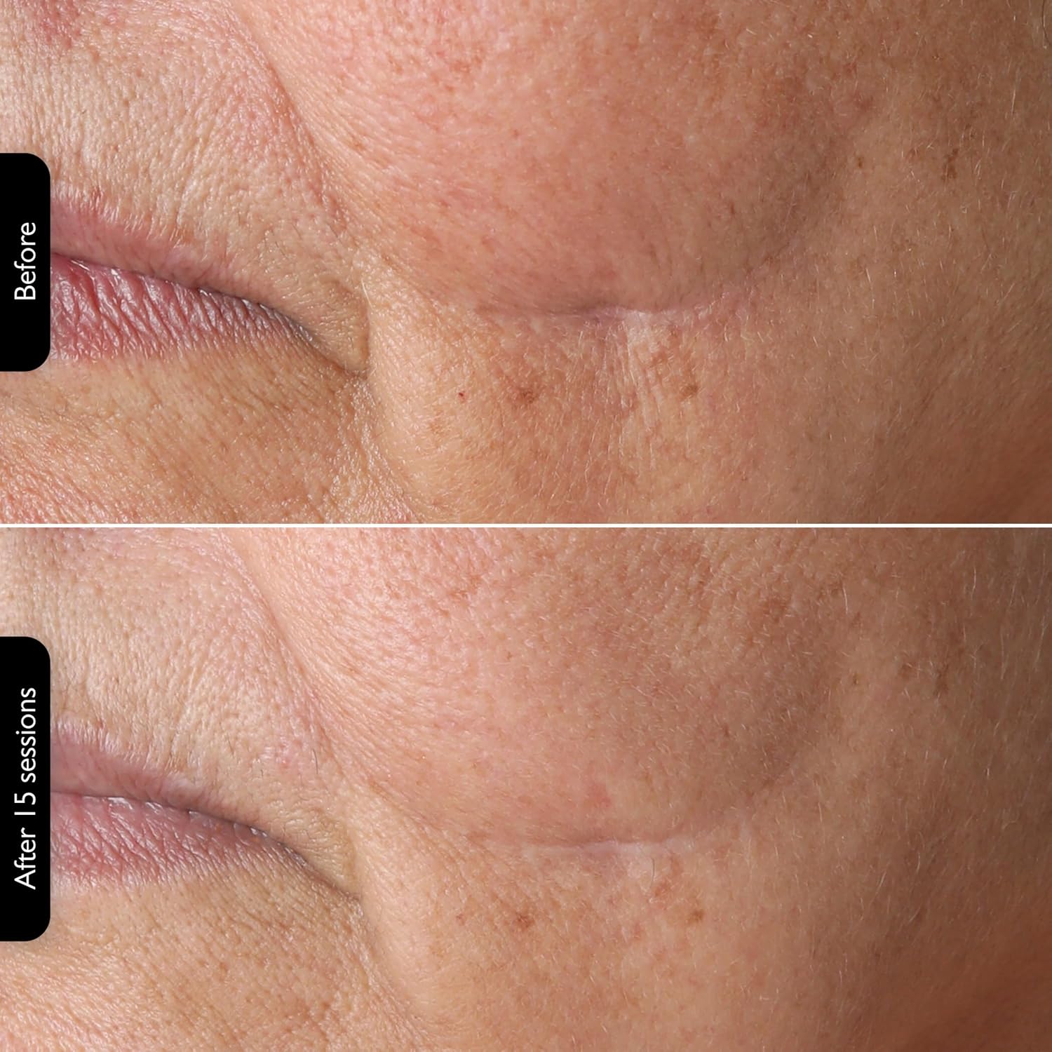 Silk'n Titan Multiplatform At-Home 3-in-1 Radio Frequency Skin Tightening Device for Face and Neck, Combines RF with Low-Level Laser Therapy & Red Light Therapy, with Thermal Sensor, Cordless