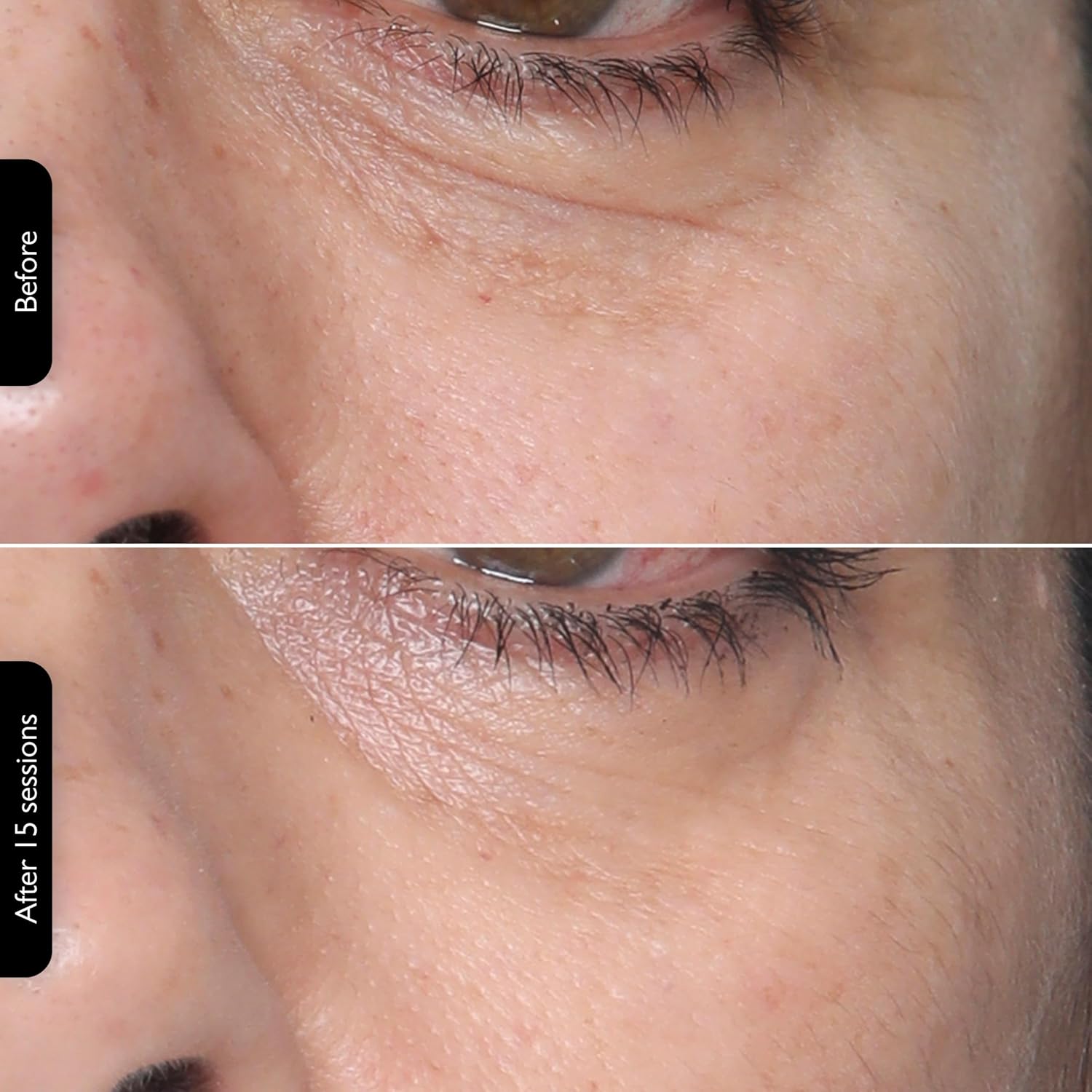 Silk'n Titan Multiplatform At-Home 3-in-1 Radio Frequency Skin Tightening Device for Face and Neck, Combines RF with Low-Level Laser Therapy & Red Light Therapy, with Thermal Sensor, Cordless